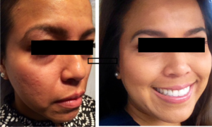 Microneedling results in Greenville, SC