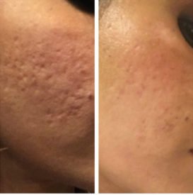 Greenville MDPen results