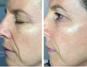 Greenville Microneedling Results